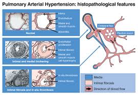 Pulmonary Arterial Hypertension - Hình ảnh minh họa
